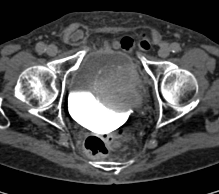 does abdominal ct scan show bladder cancer Updated