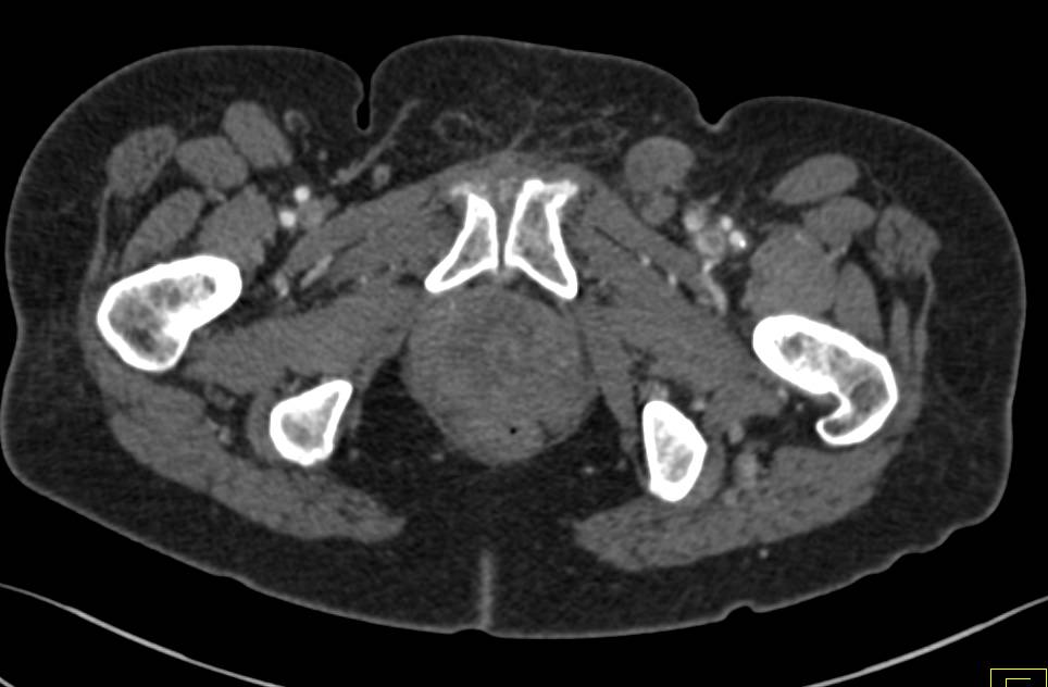 Abscess of the Prostate Gland - CTisus CT Scan