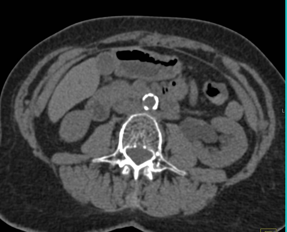 Bladder Cancer Obstructing the Left Kidney - CTisus CT Scan