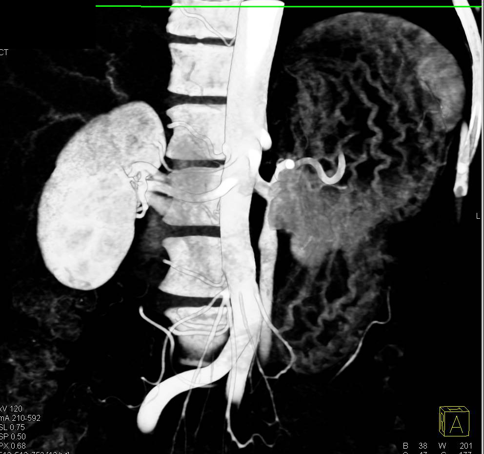 Dilated Left Gonadal Vein and Pelvic Congestion Syndrome - CTisus CT Scan