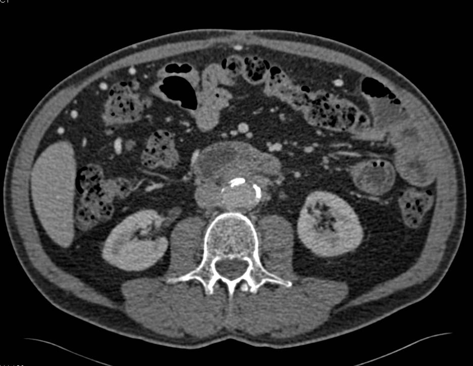 Retroperitoneal Fibrosis - CTisus CT Scan