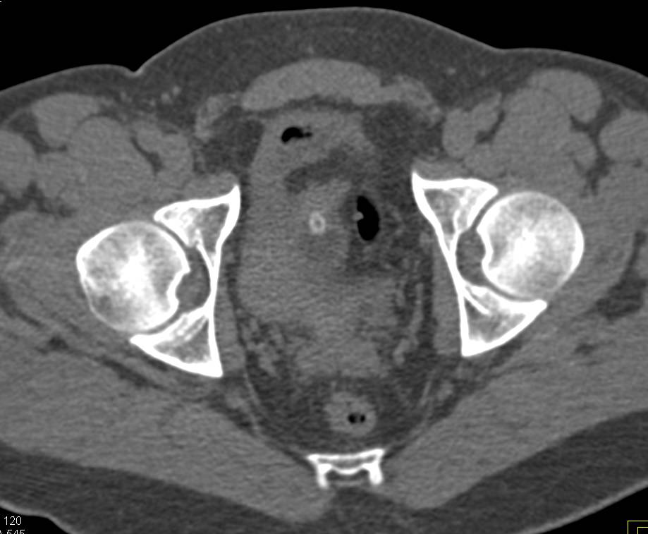 Normal CT Cystogram - CTisus CT Scan