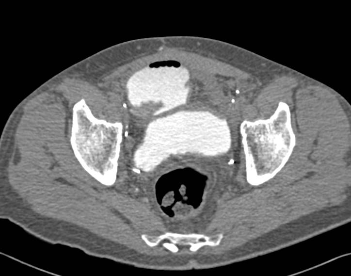 CT Cystogram of a Neobladder - CTisus CT Scan