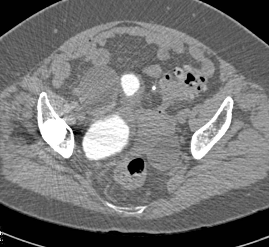 CT Cystogram with Bladder Cancer - CTisus CT Scan