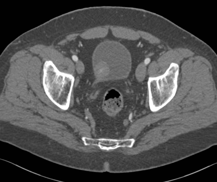 Bladder Cancer in Multiple Perspectives - CTisus CT Scan