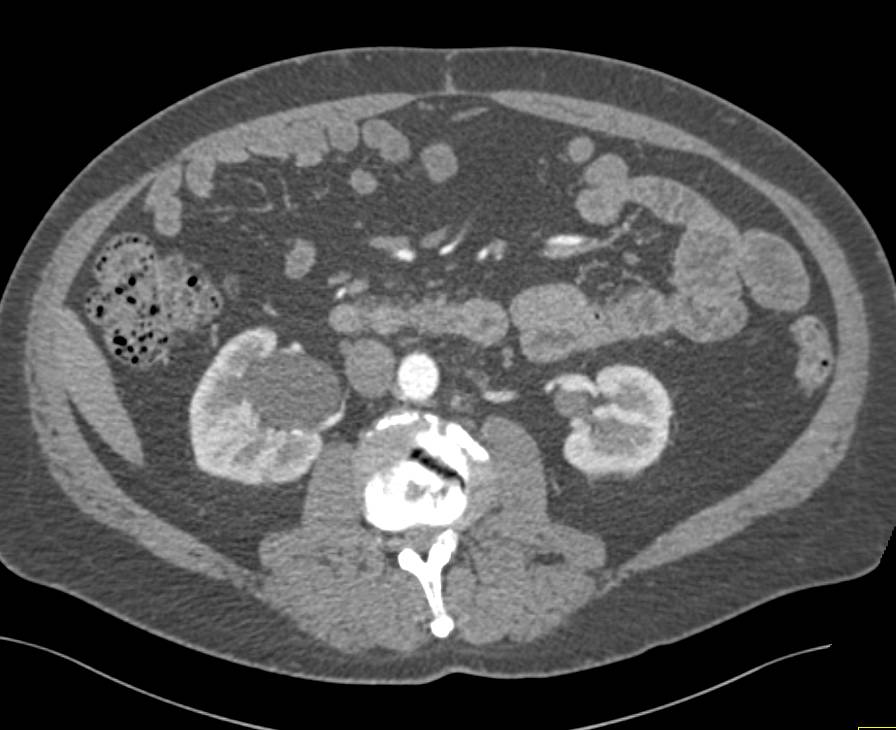 Bulky Bladder Cancer - CTisus CT Scan