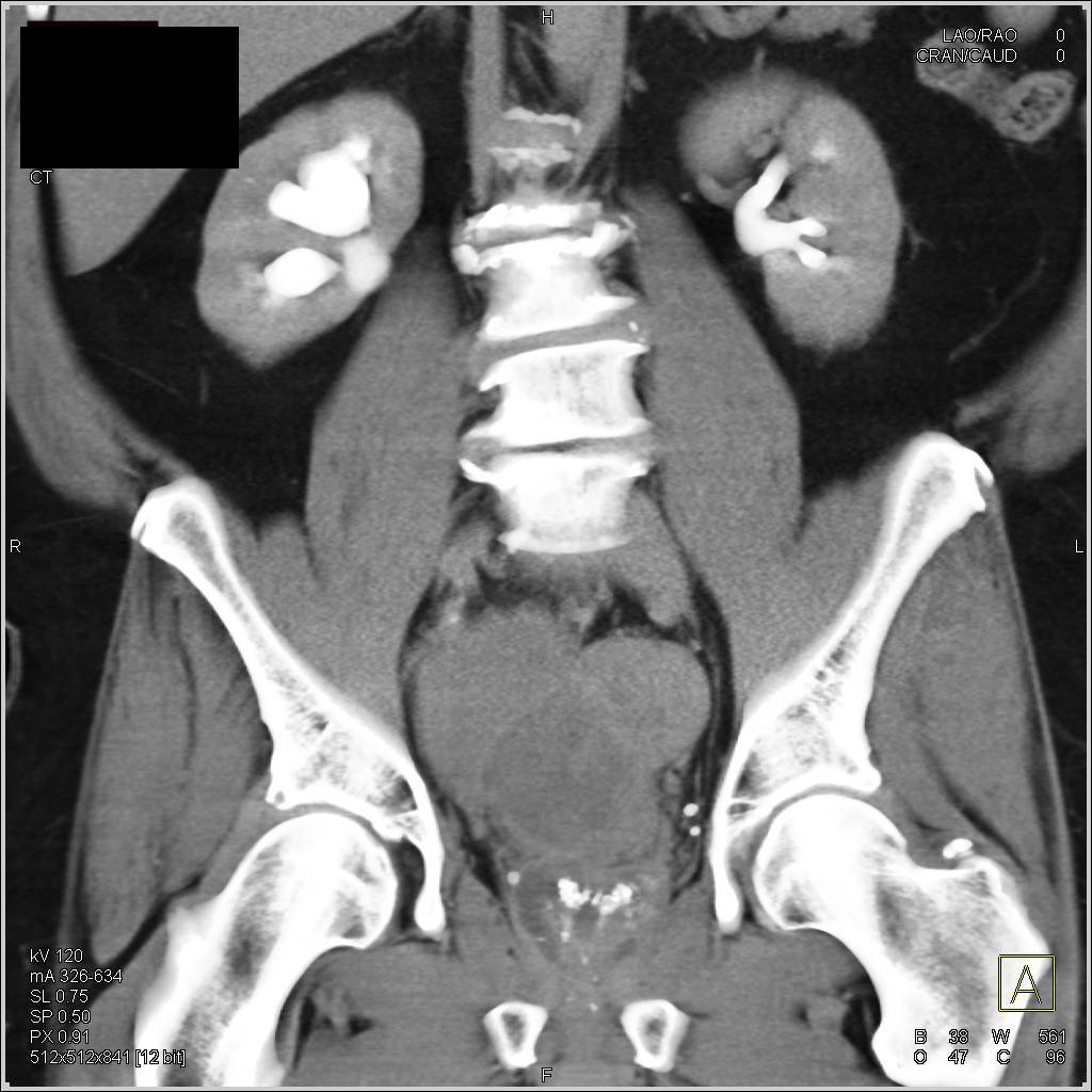 3D Display of Bulky Bladder Cancer - CTisus CT Scan