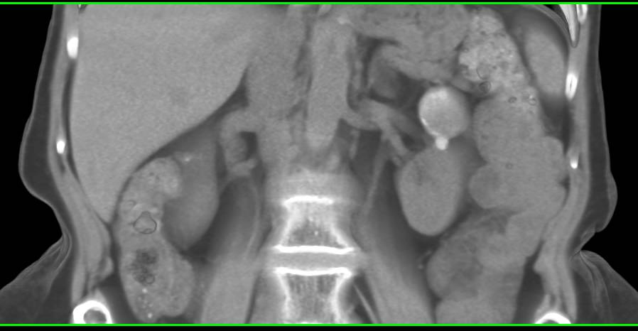 CT Cystogram shows Bladder Contrast Extravasation in Patient s/p Prostatectomy - CTisus CT Scan