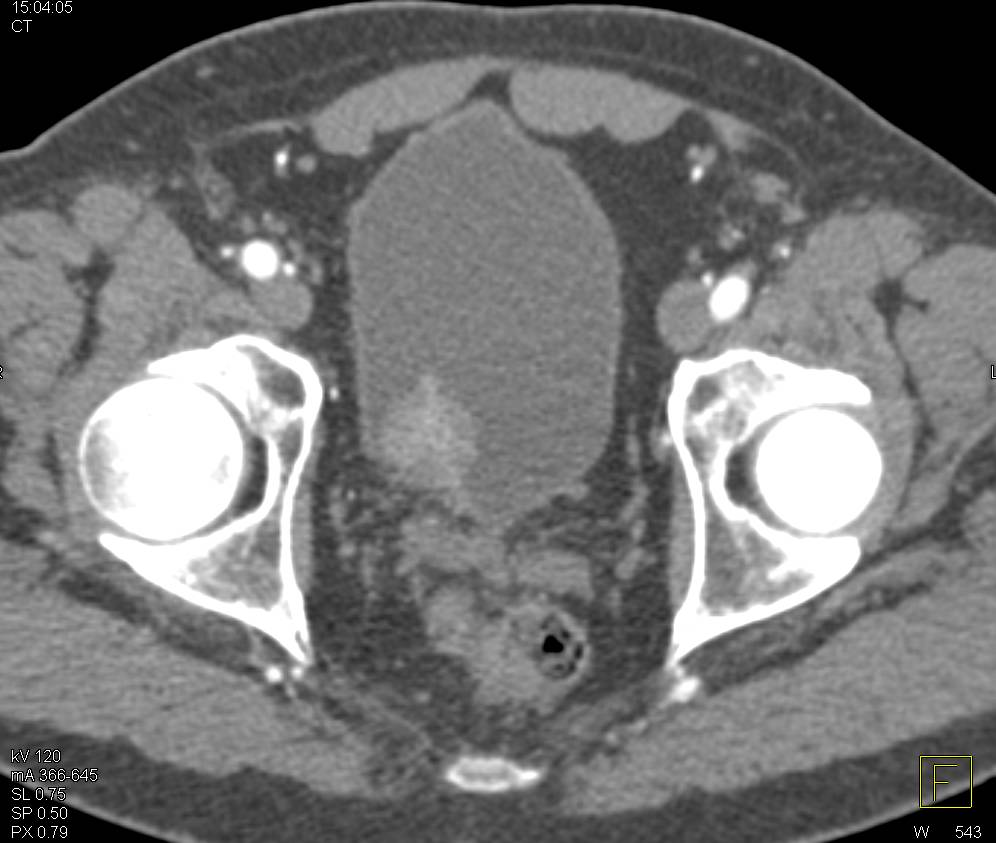 Bladder Cancer in Multiple Perspectives - CTisus CT Scan