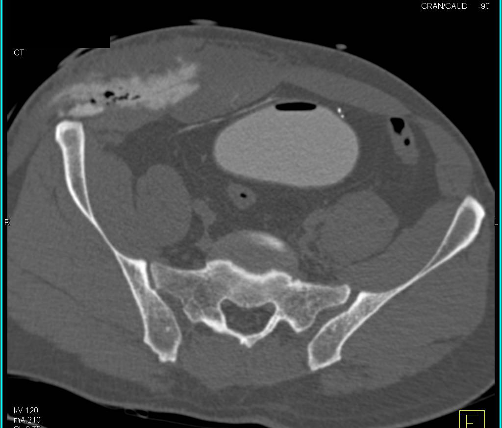 CT Cystogram shows Bladder Contrast Extravasation Extraperitoneal Type s/p Trauma - CTisus CT Scan