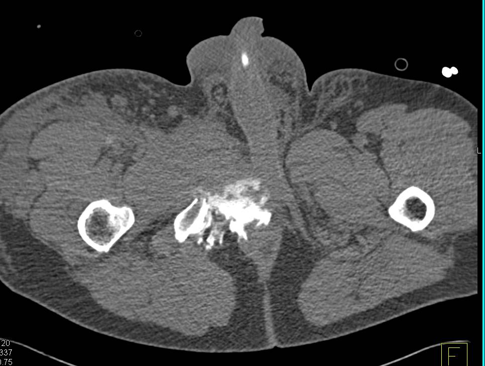 Pelvic Fractures with CT Cystogram Showing Extraperitoneal Extravasation of Contrast From the Bladder - CTisus CT Scan