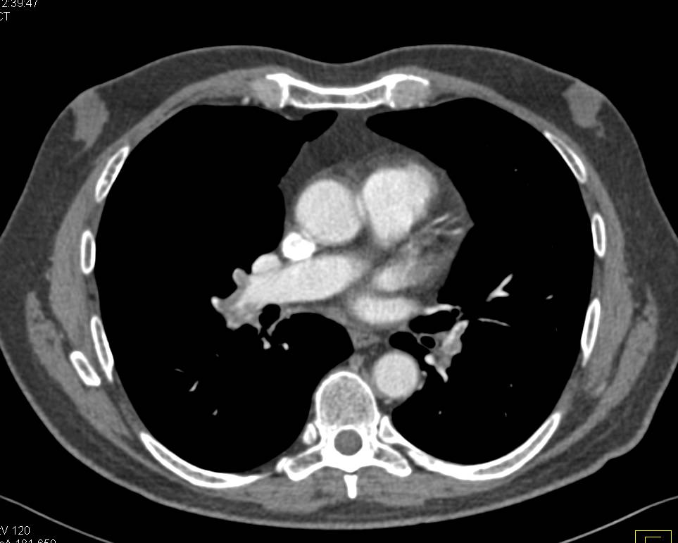 Patient with Cystectomy for Bladder Cancer and Ileal Loop has Local Recurrence with Invasion of Symphysis Pubis - CTisus CT Scan