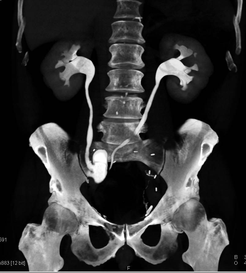 Patient with Cystectomy for Bladder Cancer and Ileal Loop ...