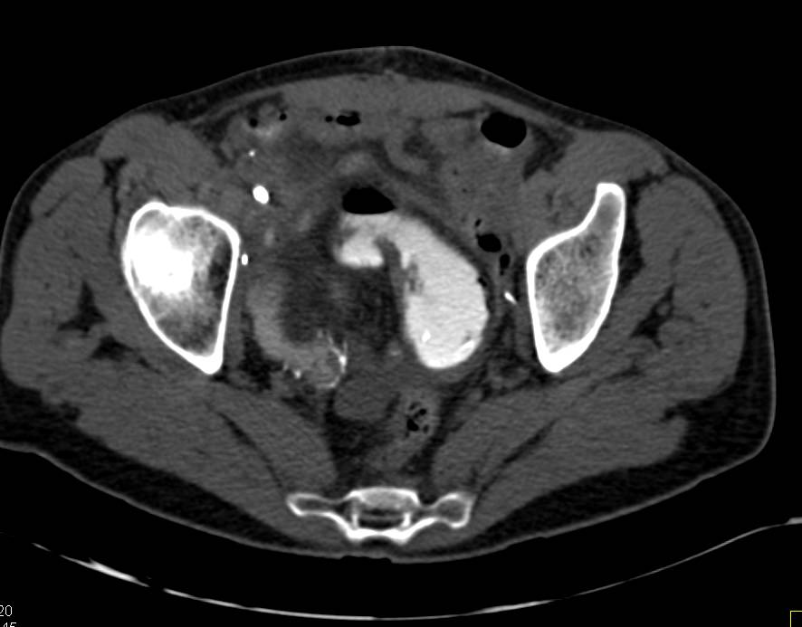 Neobladder - CTisus CT Scan