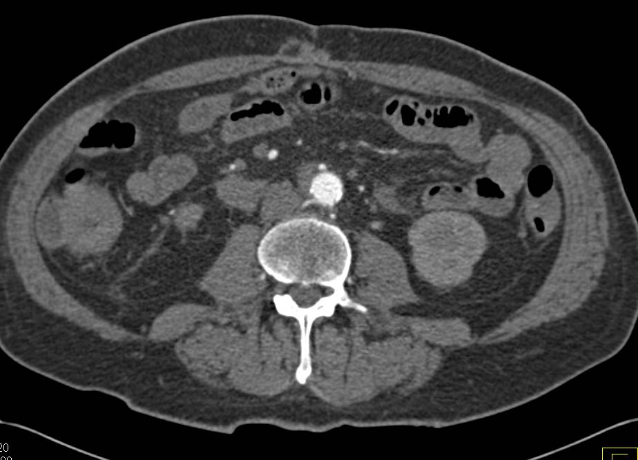 Carcinoma of the Right Ureter - CTisus CT Scan