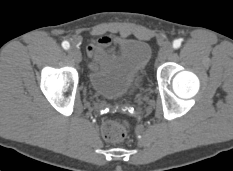 Seminal Vesicle Calcifications in a Diabetic - CTisus CT Scan