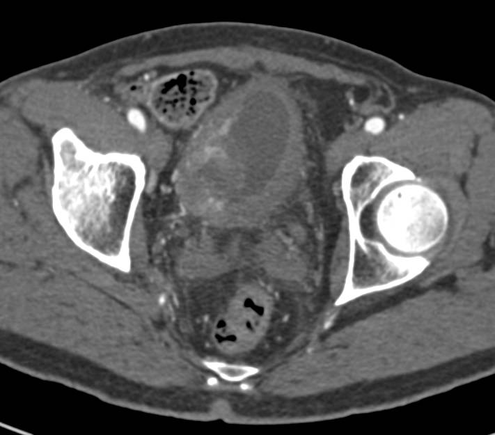 Bulky Bladder Cancer at Early and Late Phase of Acquisition in Both 2D and 3D Display - CTisus CT Scan