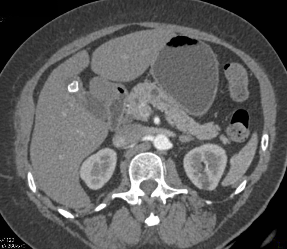 Extrarenal Paraganglioma in the Right Lower Quadrant - CTisus CT Scan