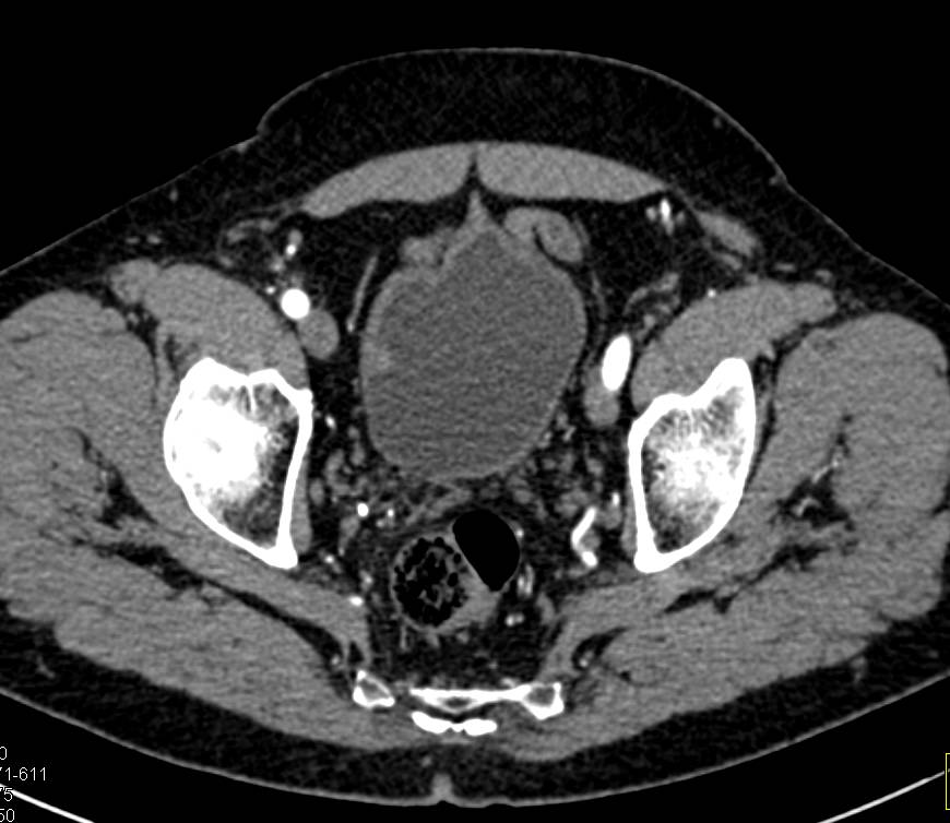 Subtle Bladder Cancer - CTisus CT Scan