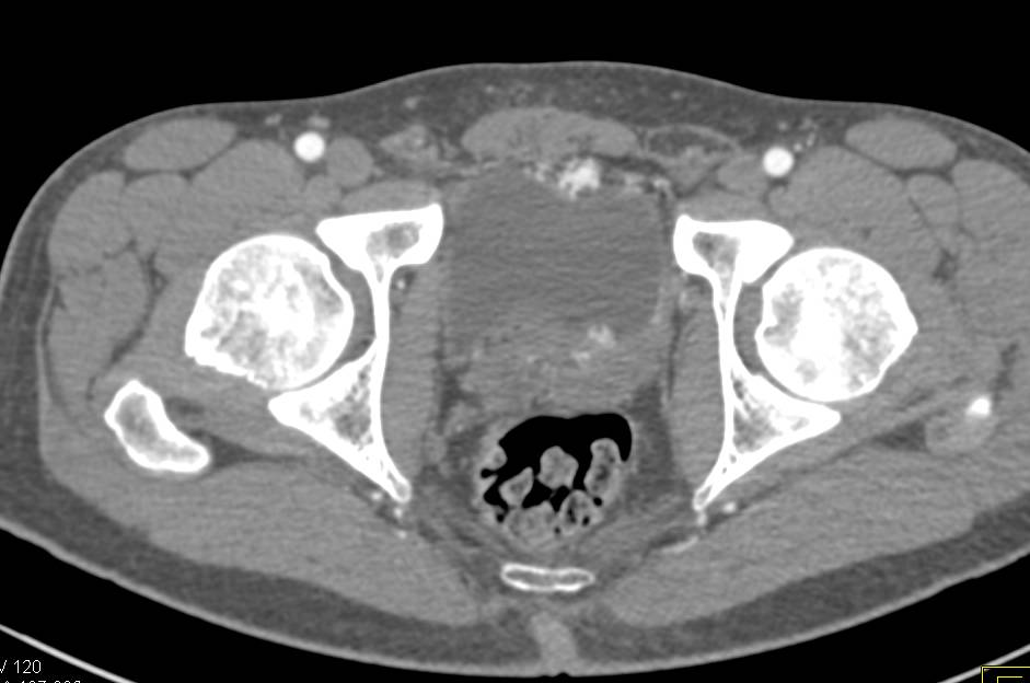 Vascular Malformation in the Anterior Bladder Wall - CTisus CT Scan