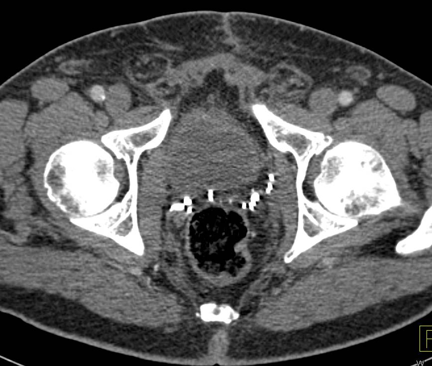 Seroma Following Prostatectomy in Right Lower Quadrant. Incidental Intraductal Papillary Mucinous Neoplasm (IPMN) also seen - CTisus CT Scan