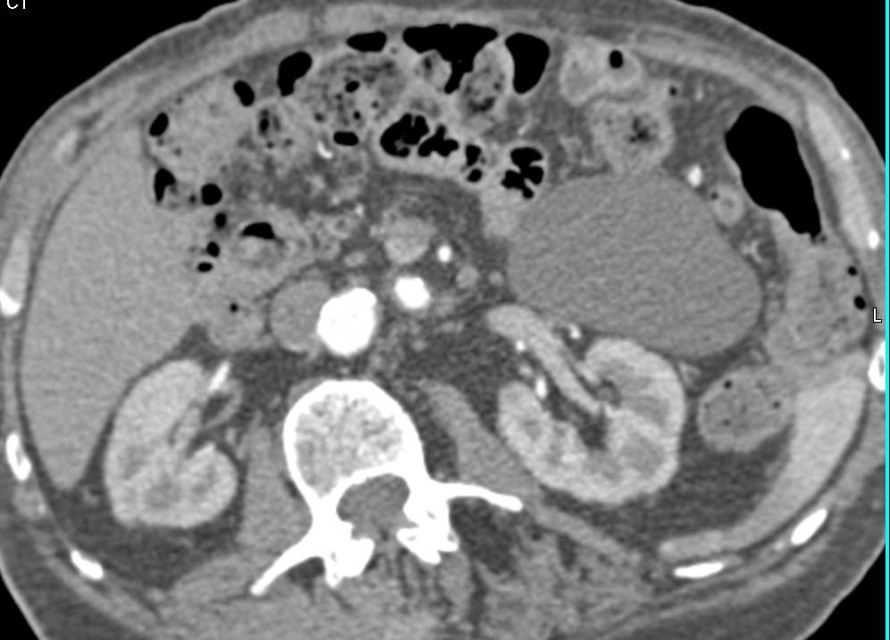 Lymphangioma - CTisus CT Scan