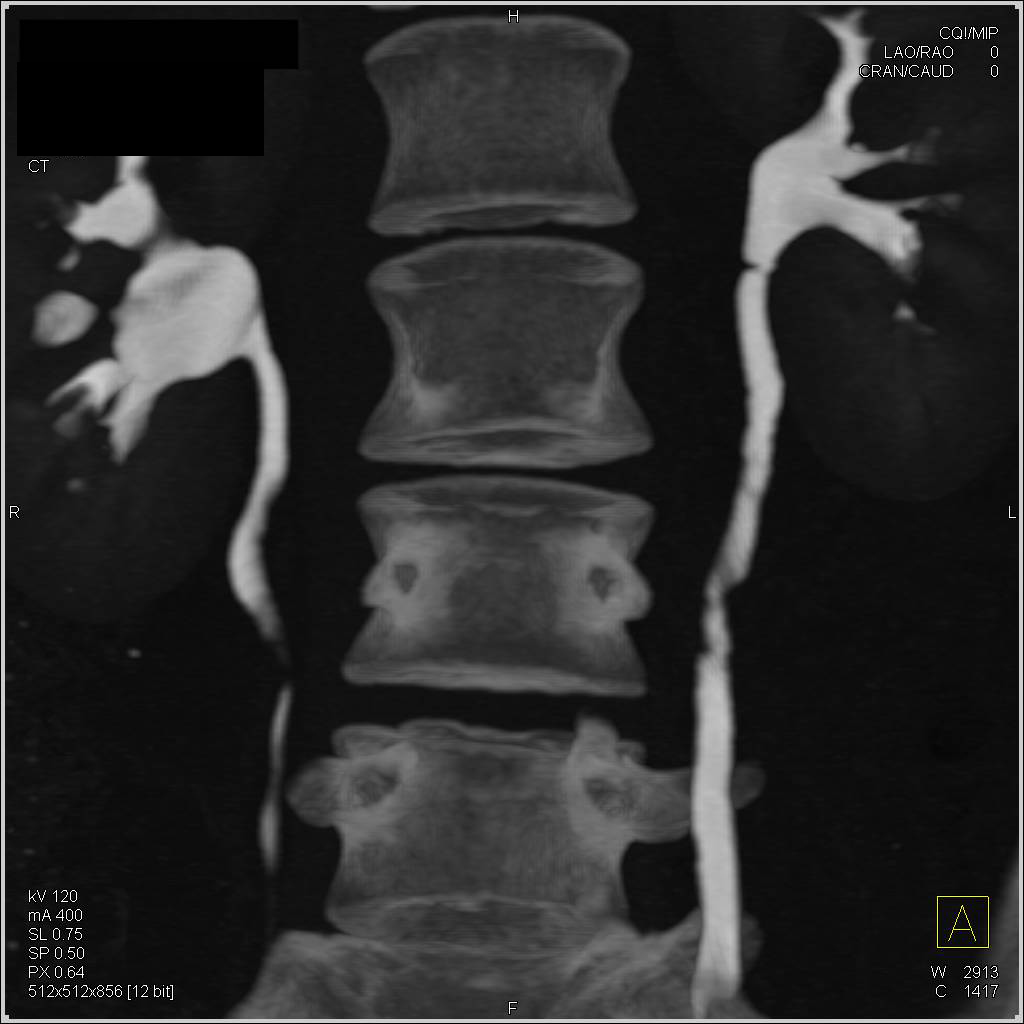 Transitional Cell Carcinoma of the Left Ureter - CTisus CT Scan