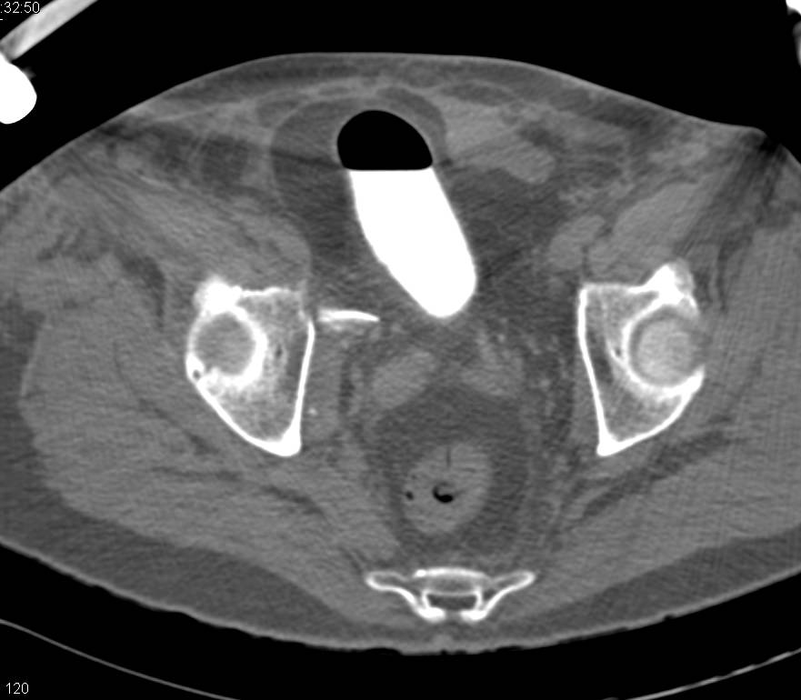 Suprapubic Catheter with Large Urinoma in Upper Right Thigh - CTisus CT Scan