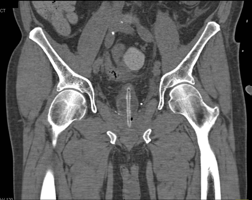 Bladder Perforation due to Laproscopic Prostatectomy - CTisus CT Scan