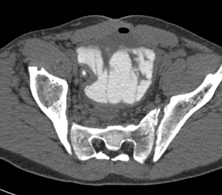 Neobladder without a Leak - CTisus CT Scan