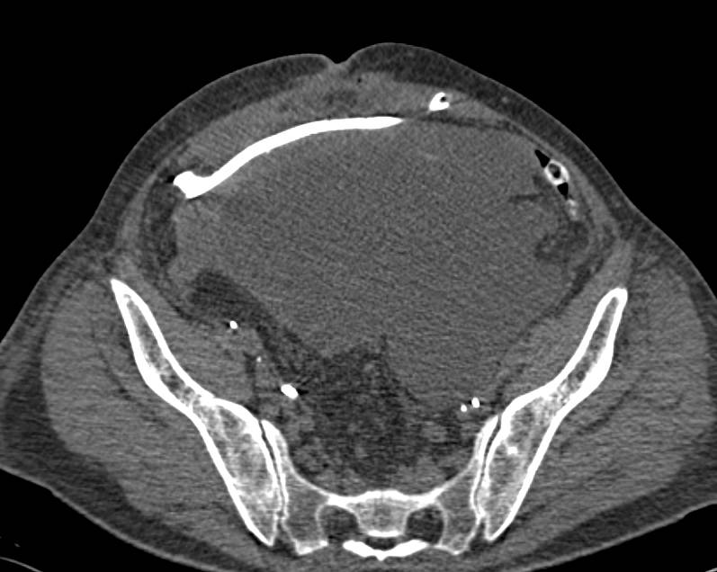 Neobladder Simulates a Pelvis Abscess When Not Distended - CTisus CT Scan