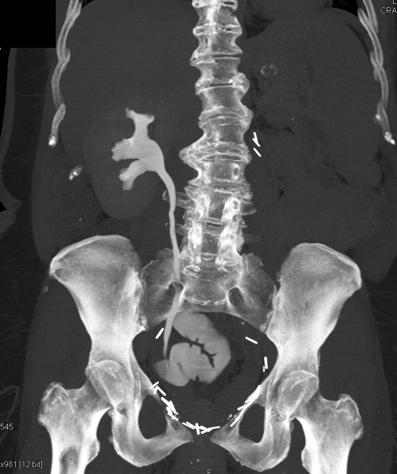 Cystoprostatectomy with Nephrectomy and Ileal Loop on CT Urography - CTisus CT Scan