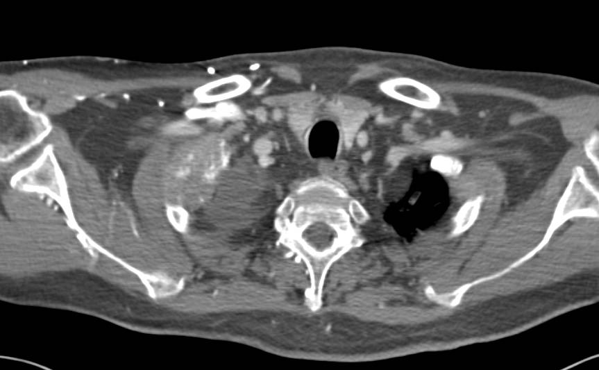 Metastatic Bladder Cancer with Multiple Bladder Tumors and Bone Metastases - CTisus CT Scan