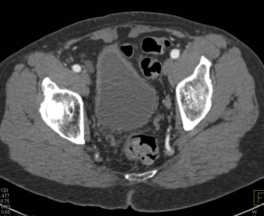 Subtle Urachal Carcinoma Best Seen on Sagittal View - CTisus CT Scan