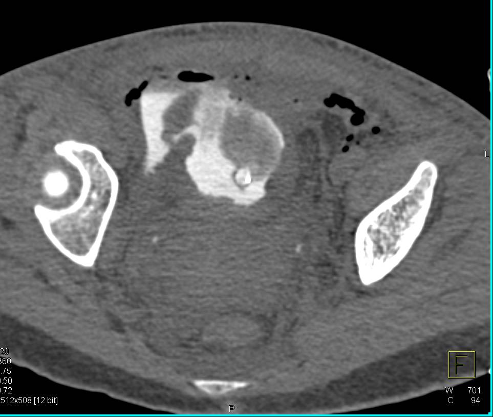 Extraperitoneal Bladder Perforation - CTisus CT Scan