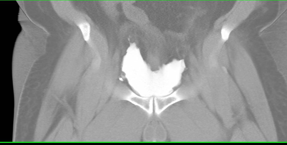 Bladder Perforation s/p Prostatectomy - CTisus CT Scan