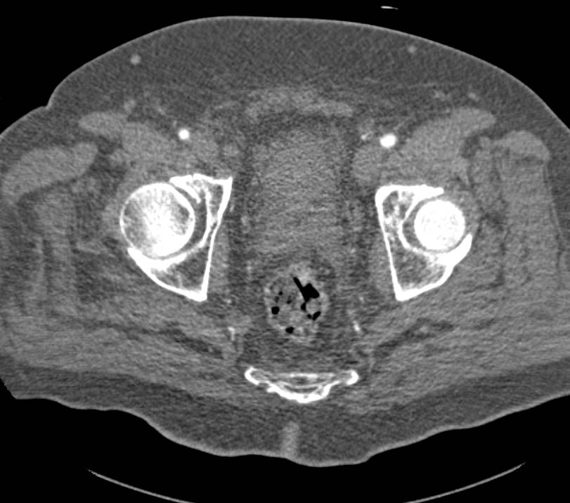 Acute Cystitis - CTisus CT Scan