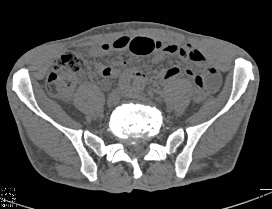 CT Cystogram with Fistulae to the Rectum - CTisus CT Scan