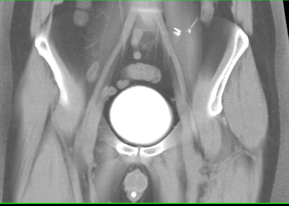 Normal CT Cystogram - CTisus CT Scan