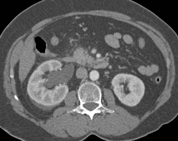 Obstructed Right Kidney due to Distal Stone in Ureter - CTisus CT Scan