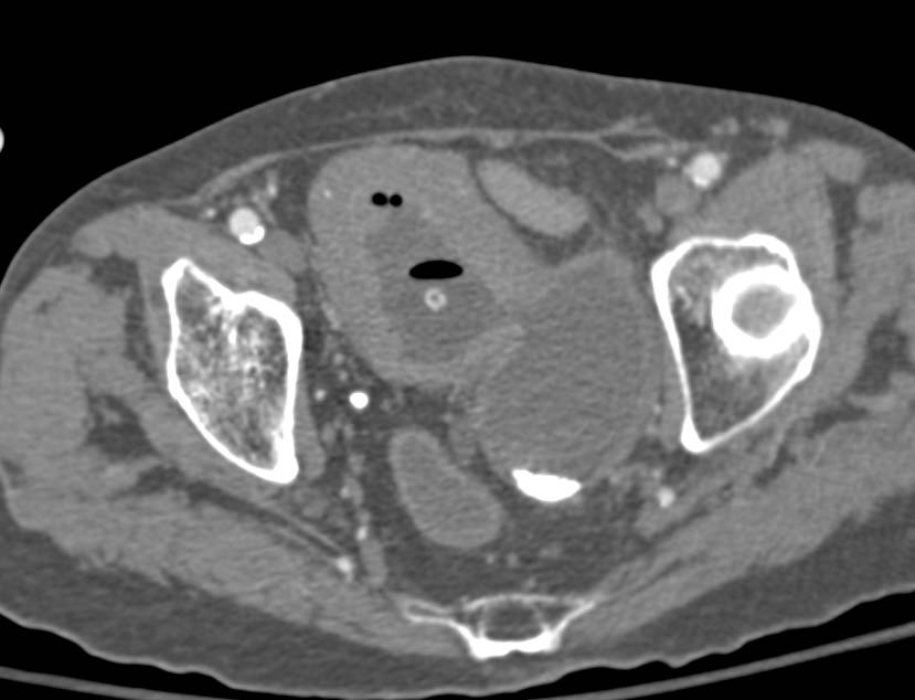 Large Left Sided Bladder Diverticulum - CTisus CT Scan