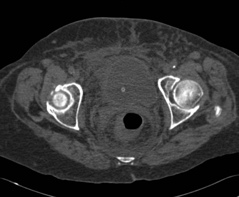 Fistulae Between Bladder and Colon - CTisus CT Scan