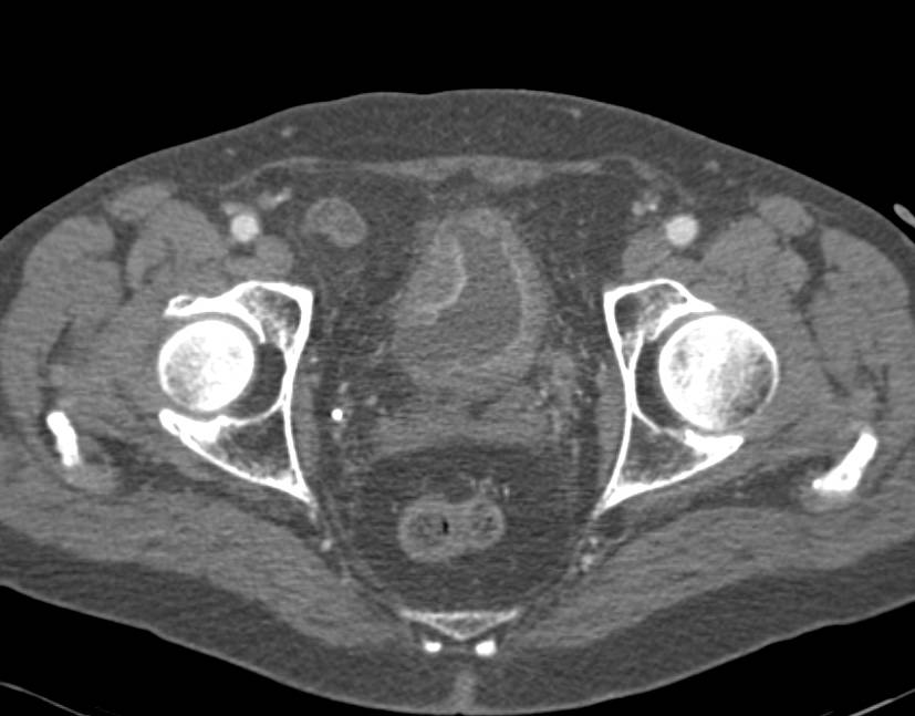 Bladder Cancer - CTisus CT Scan