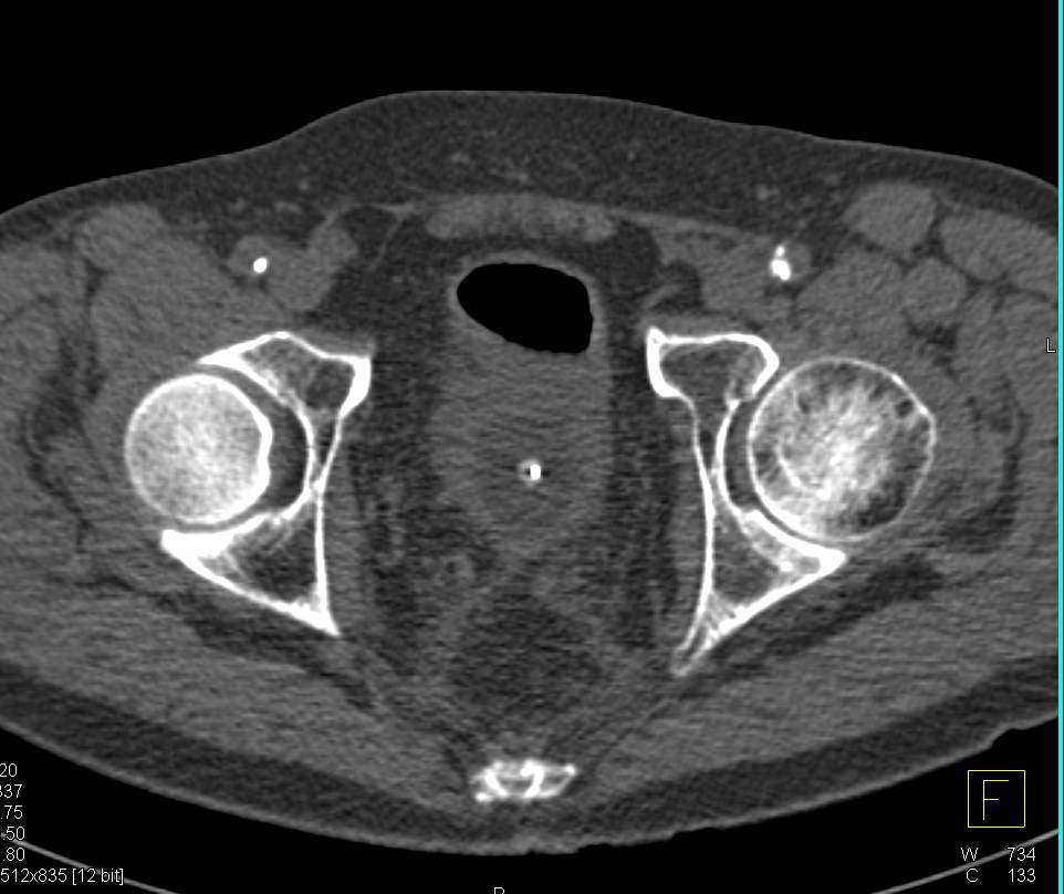 Normal CT Cystogram - CTisus CT Scan