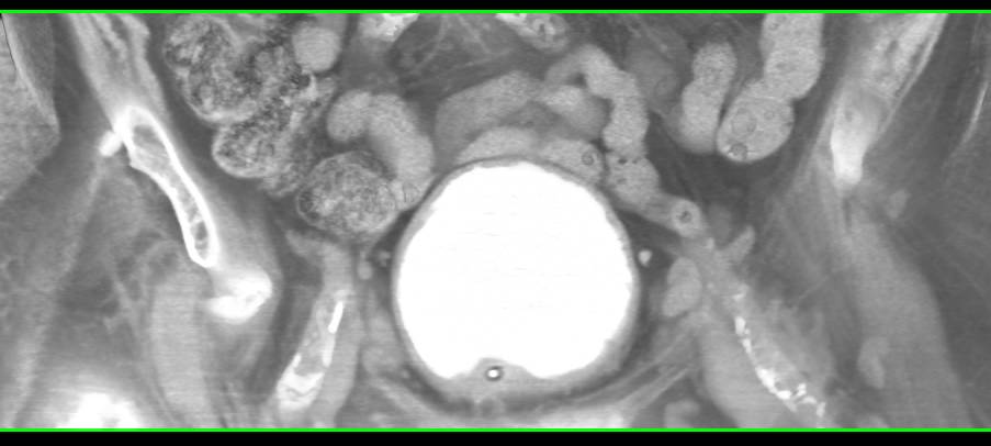 Thickening of the Base of the Bladder - CTisus CT Scan