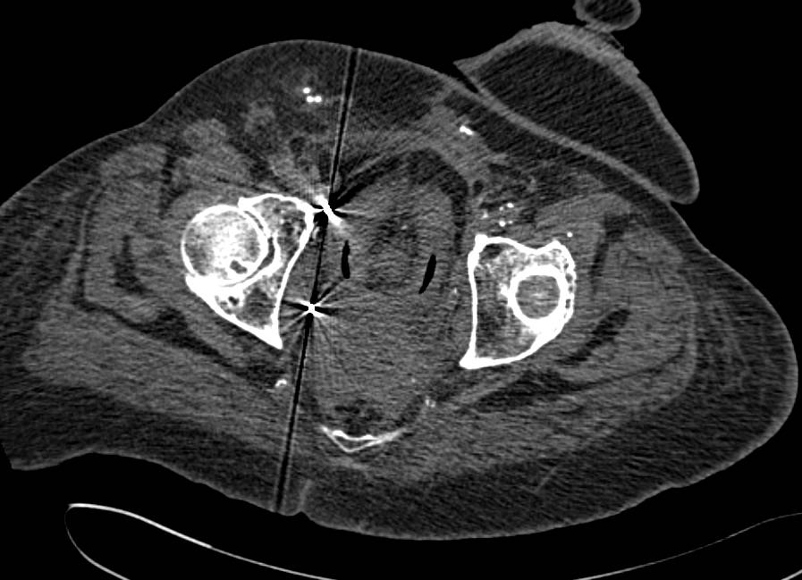 CT Cystogram with Fistulae to the Rectum - CTisus CT Scan