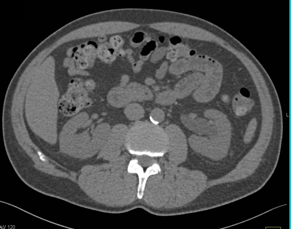 Left Hydronephrosis with Bladder Cancer - CTisus CT Scan