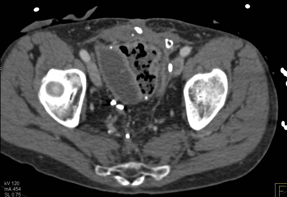 Post-Op Pelvic Abscess - CTisus CT Scan