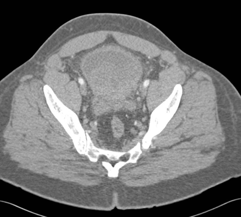 Bladder Cancer - CTisus CT Scan