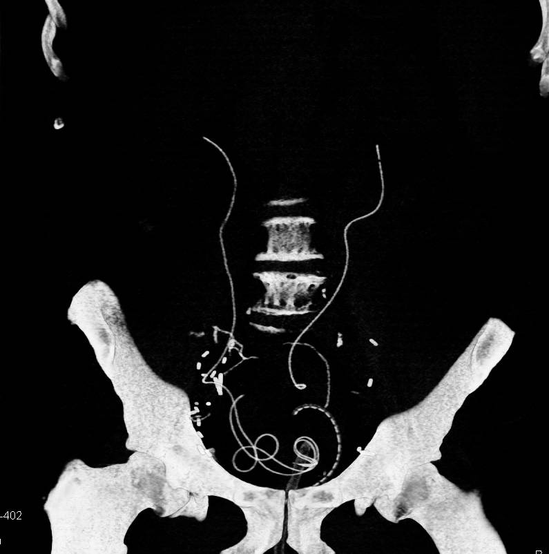 Bladder Leak Following Surgery - CTisus CT Scan